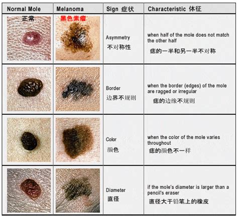 腹部長痣|痣也可能会癌变！长在 3 个地方要注意